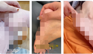 请勿使用皮肤干裂起皮、起屑、轻微干裂伤口等影响用户体验的素材设计，如【视频中展现干裂起皮、起屑场景】，请修改