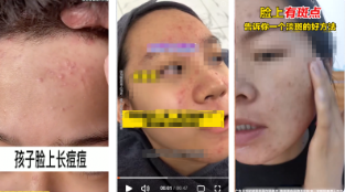 请勿使用痘痘/斑点成团成簇影响用户体验的素材设计，如【视频中展现痘痘点形象泛红成簇、斑点密集场景】，请修改